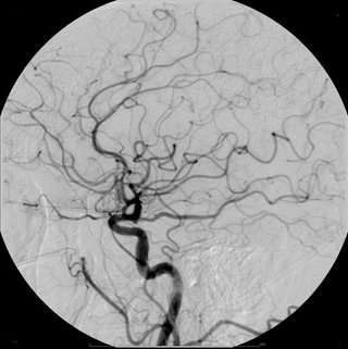 Illustration for article titled The First Angiogram Patient Nearly Died Of Terror